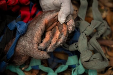 Closeup of the scorched hand of an orangutan rescued from wildfires in a palm oil plantation area, Ketapang, West Kalimantan, Indonesia.