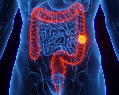 What is colorectal cancer and is it preventable? | Well actually | The Guardian