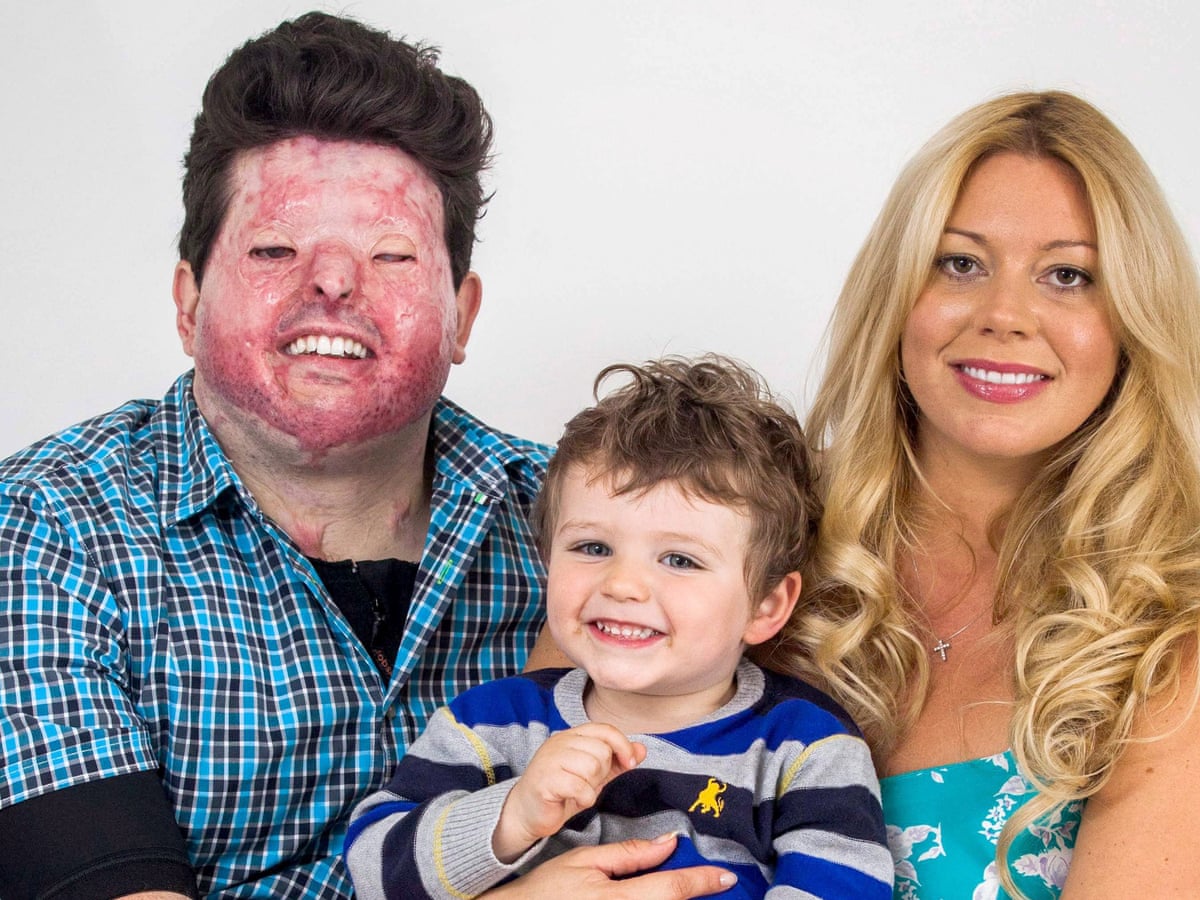 Father badly burned in acid attack says he will not be overwhelmed by injuries | UK news | The Guardian