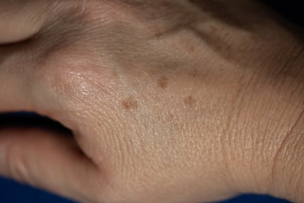 Close up of sunspots on the hands of a middle-aged woman