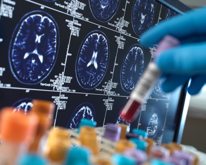 Researchers warn social media is driving harmful misuse of Alzheimer’s blood tests