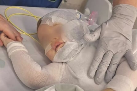 A supplied image obtained in August 2025 shows baby Luka after he was attacked with hot coffee in 2024