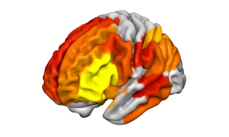 Functional magnetic resonance imaging (fMRI) scan of a brain shows regions of increased connectivity on DMT. Connectivity rises from yellow to orange to red. 