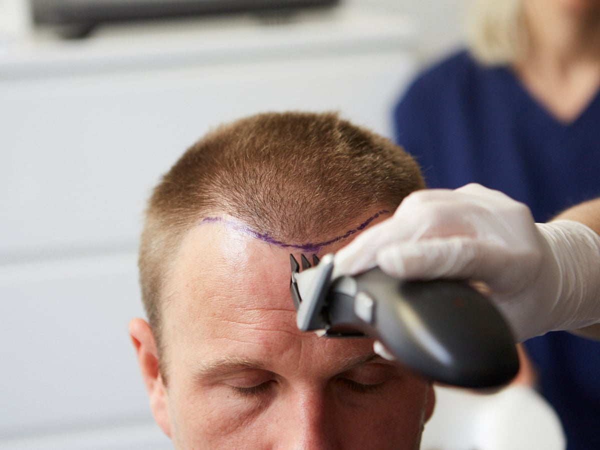 The Hair Wellness Industry Men Said They Would Rather Have A Small Penis Than Go Bald Hair Loss The Guardian