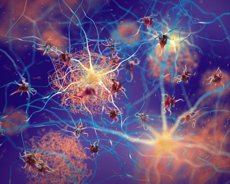 Amyloid plaques forming between neurons illustration