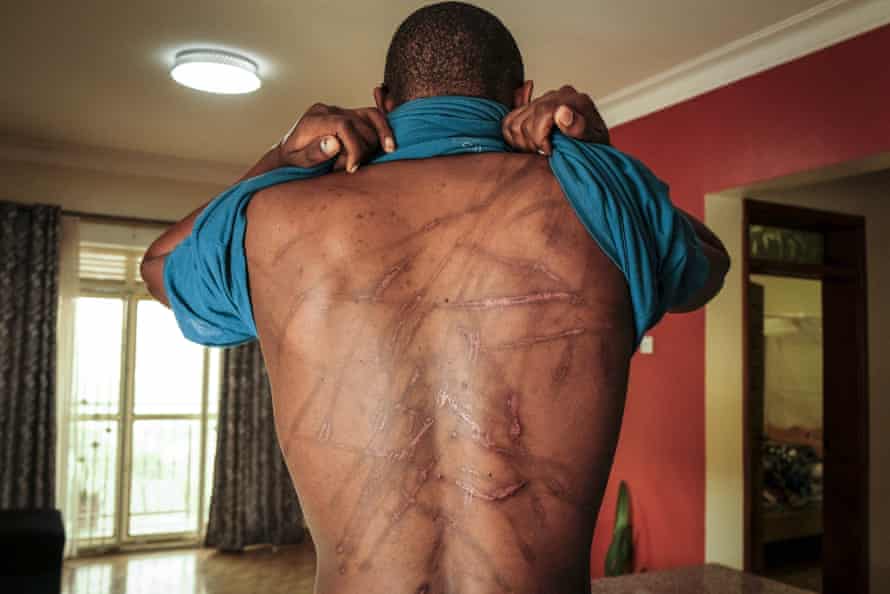 The author Kakwenza Rukirabashaija shows the welts he says he received when he was tortured in custody.