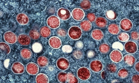 Colourised transmission electron micrograph of monkeypox particles