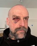 Michael Angove, 51: he has a shaven head and greying beard – and in this picture, one very bloodshot eye with pronounced bruising around it. He wears a black hoodie and has tattoos on his neck.