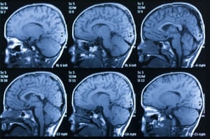 MRI scan of a brain
