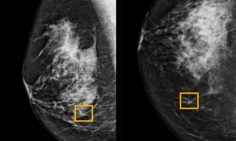A yellow box indicates where an AI system found cancer hiding inside breast tissue. Six previous radiologists failed to find the cancer in routine mammograms.