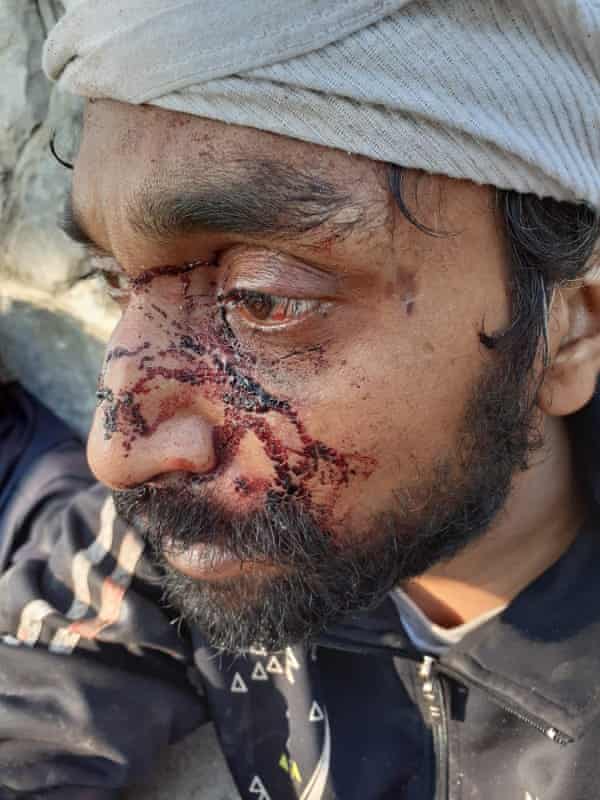 One of the migrants attacked by men wearing balaclavas