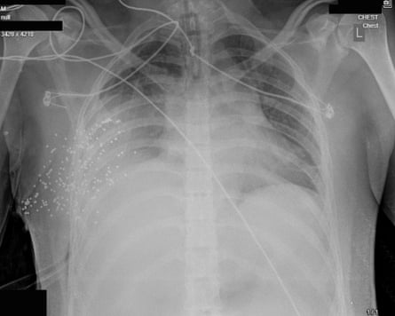 X-ray image of a person’s chest with lots of tiny white dots clustered on one side of the chest.