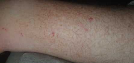 Bed bug bites on Unison resident Jack Kramme, who says he wakes up each night covered in bites due to an infestation in his community housing building in Melbourne.