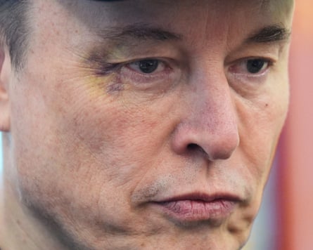 Man with black eye looking down