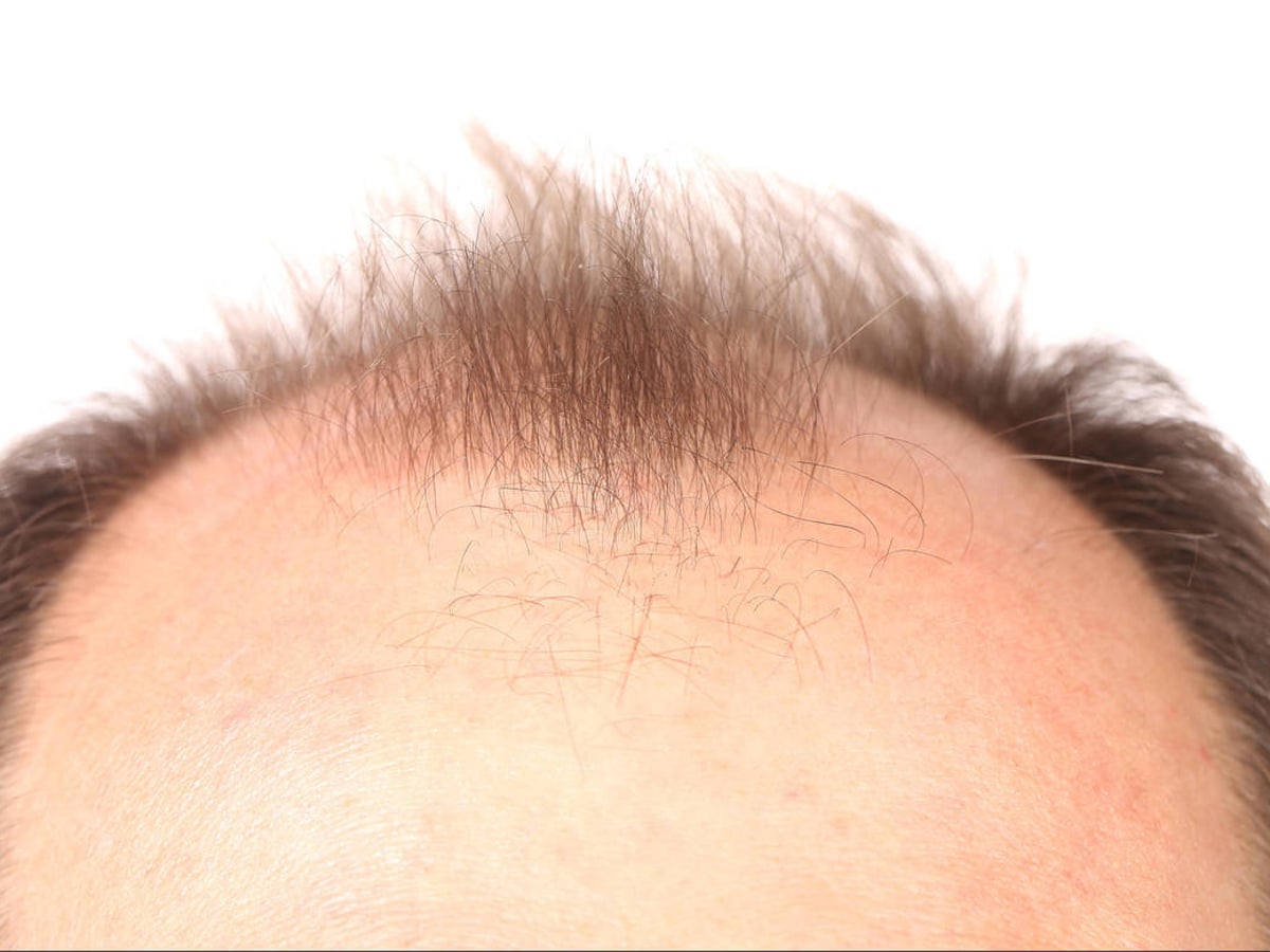Hair loss can be traumatic for men too | Hair loss | The Guardian