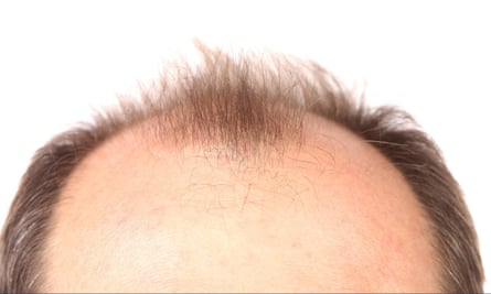 Male pattern baldness affects around 85% of men by the age of 50.