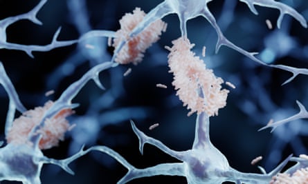 A computer-generated image of amyloid plaques – misfolded proteins that aggregate between neurons.