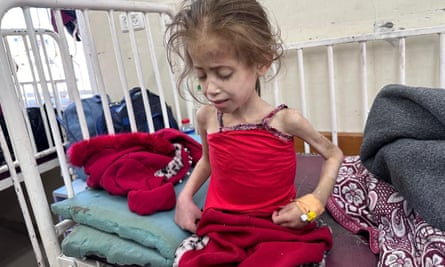 An extremely underweight young girl sits on a hospital bed