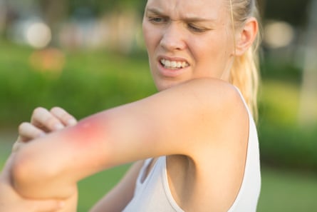 Female with redness on her arm from an insect bite at the park on a summer day. She looks in pain and scratching.