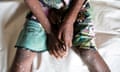The arms and legs of an African child covered by small fluid-filled blisters