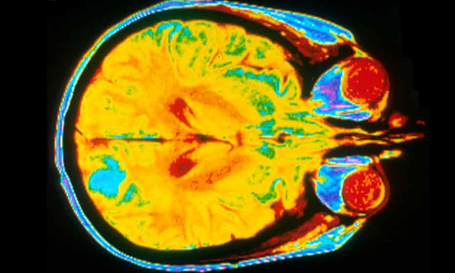Colour slides of a single image of a human brain using an MRI machine