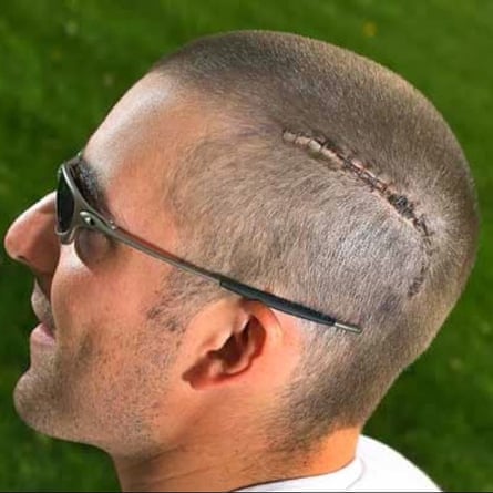 A long horizontal scar across the side of Bruce Moncur’s head.