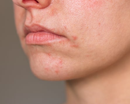 A closeup of a woman with red spots around her mouth and nose