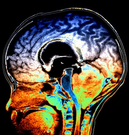 This colour-enhanced, sagital (from the side), T1-weighted MR image shows a large mass arising from the vermis/roof of the fourth ventricle and filling it, severely compressing the brainstem and causing obstructive hydrocephalus in addition to downward herniation of the cerebellar tonsils. This is a medulloblastoma, an aggressive type of primitive neuroectodermal tumour (PNET) which can seed the subarachnoid spaces with metastatic foci. Medulloblastomas are one of the most common posterior fossa tumours of childhood. Credit - Science Photo Library