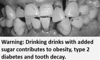 Rotten teeth health warning on sugary drinks could deter ...