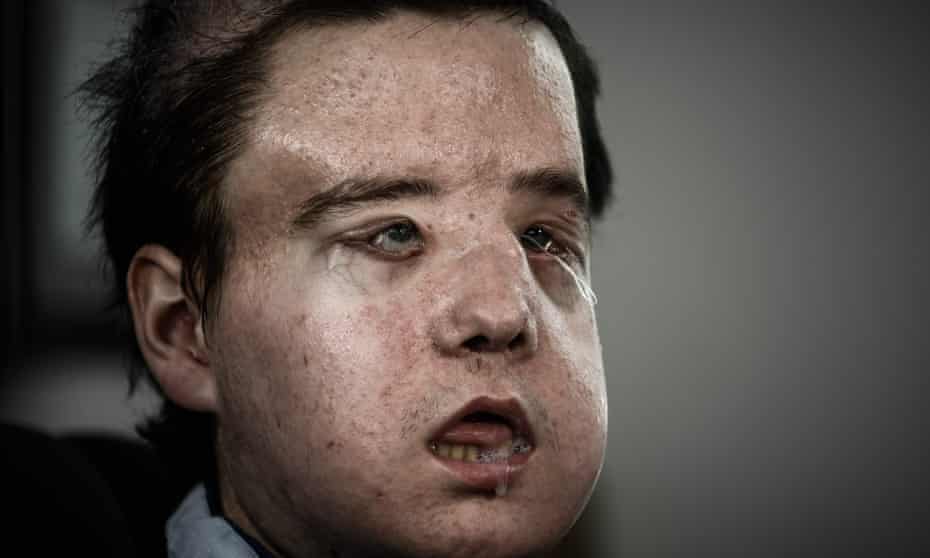 Jerome Hamon, the first man in the world to twice undergo a face transplant poses this week at the Georges-Pompidou hospital in Paris.