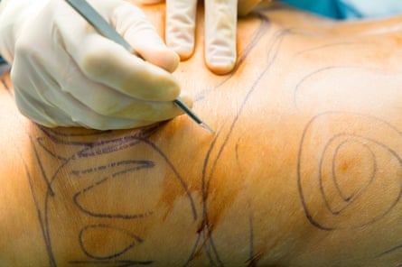 A patient being marked before a liposuction procedure.