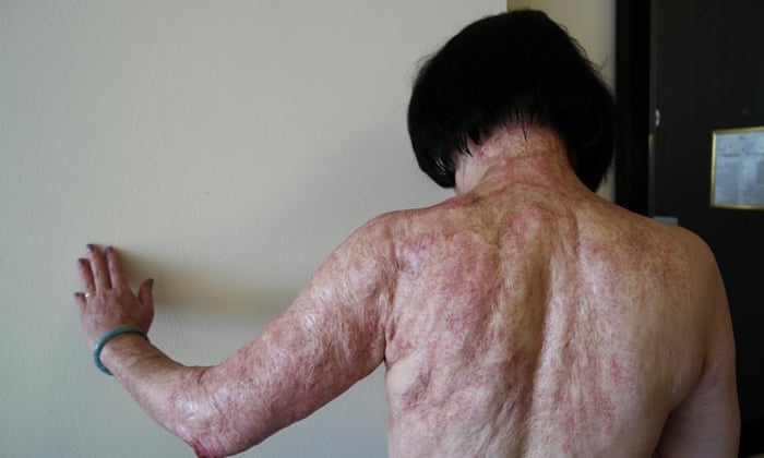 Vietnam War S Napalm Girl Kim Phuc Has Laser Treatment To Heal Wounds Us News The Guardian Vietnam War S Napalm Girl Kim Phuc Has Laser Treatment To Heal Wounds Us News The Guardian