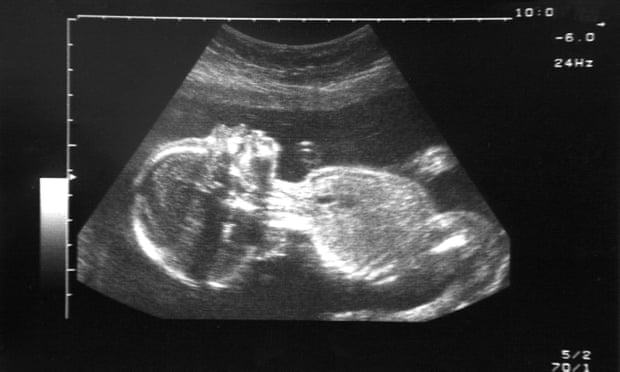 Foetal scan