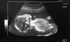 A 20-week ultrasound scan of a healthy foetus