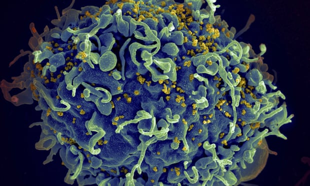 This electron microscope image made available by the US National Institutes of Health shows a human T cell, in blue, under attack by HIV, in yellow, the virus that causes Aids.