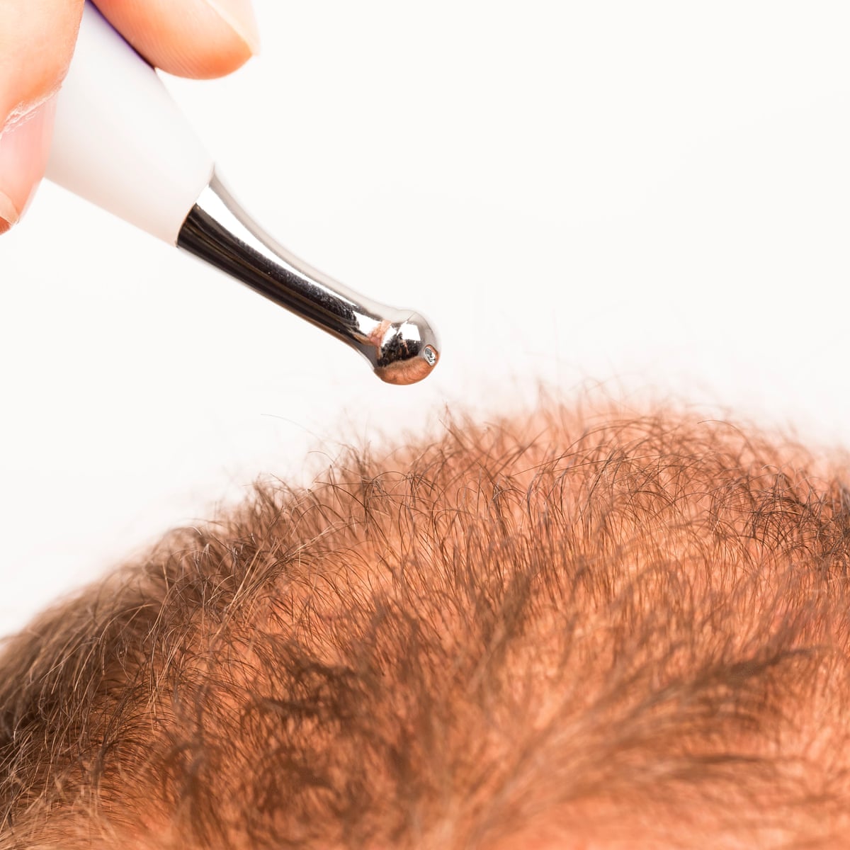 Tell us: have you had a hair transplant during the pandemic? | Men's hair |  The Guardian