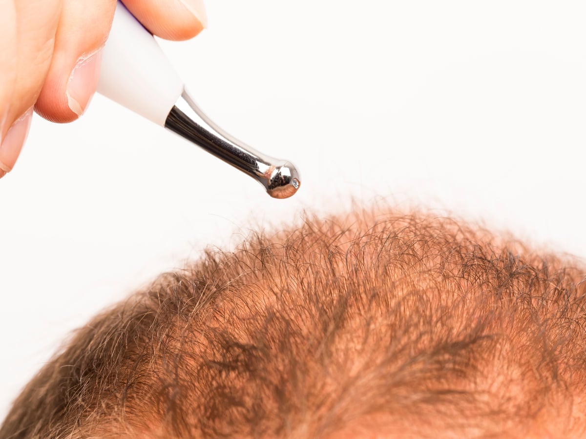 Tell us: have you had a hair transplant during the pandemic? | Men's hair |  The Guardian