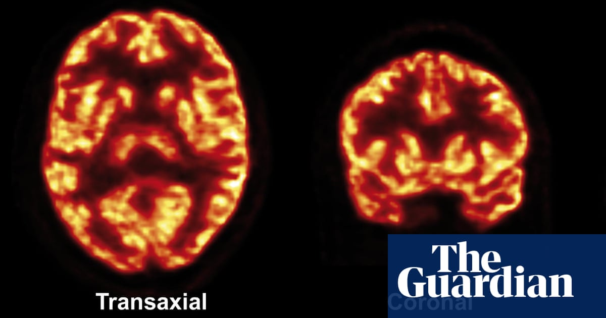 Live Imaging Of Synapse Density In The Human Brain Science The Guardian Live Imaging Of Synapse Density In The Human Brain Science The Guardian
