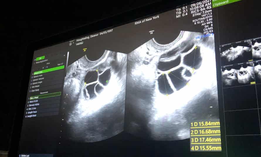 Scans of my ovaries show expanding antral follicles, doubled and tripled in size, after nearly two weeks of hormone therapy.