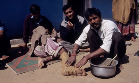 Treating snakebite with a herbal and mud paste, Madhya Pradesh, India.