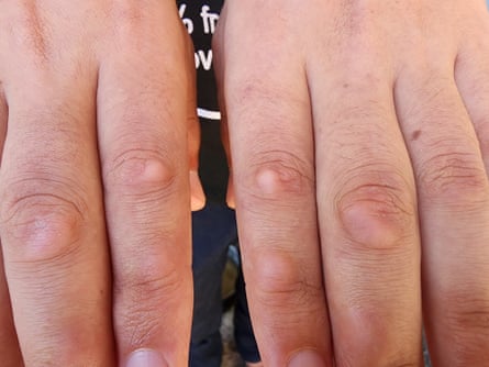 Blisters on the top of the fingers.