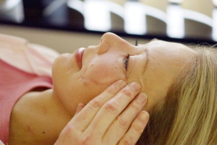 Anne Hjelle having facial therapy to reduce scar tissue and swelling in 2005.