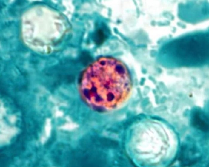 Multiple US states see alarming increase in cases of parasitic illness that causes ‘explosive’ diarrhea