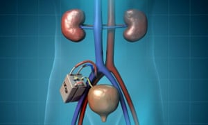 The Kidney Project’s artificial kidney.