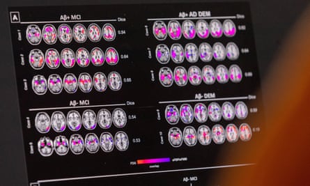 Bir bilim insanı, Cenevre Üniversitesi Hastanesi'nde Alzheimer hastası bir hastanın beynindeki metabolik ve kan akışı düzenlerinin taramalarına bakıyor