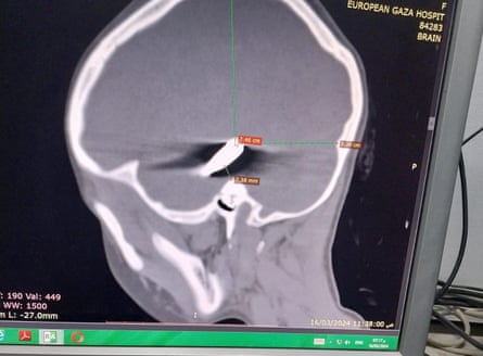 A brain scan shows a bullet lodged in the skull of an 8-year-old Palestinian girl.