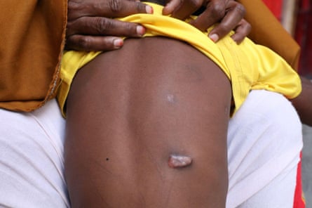 A young African boy shows shrapnel scars connected his back.
