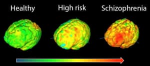 Brain images showing elevation in microglial activity in orange/red. The highest levels in schizophrenia are in the frontal cortex, involved in planning and regulating brain function, and the temporal cortex, involved in processing sounds and voices. 