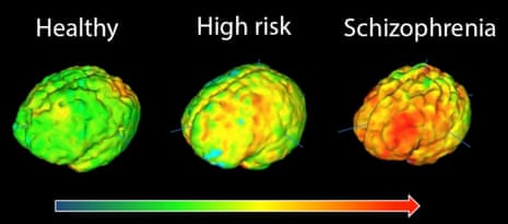 Brain images showing elevation in microglial activity in orange/red. The highest levels in schizophrenia are in the frontal cortex, involved in planning and regulating brain function, and the temporal cortex, involved in processing sounds and voices. 