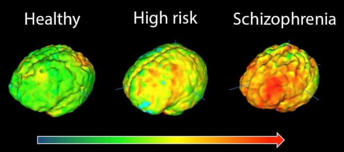 Radical New Approach To Schizophrenia Treatment Begins Trial | Schizophrenia  | The Guardian